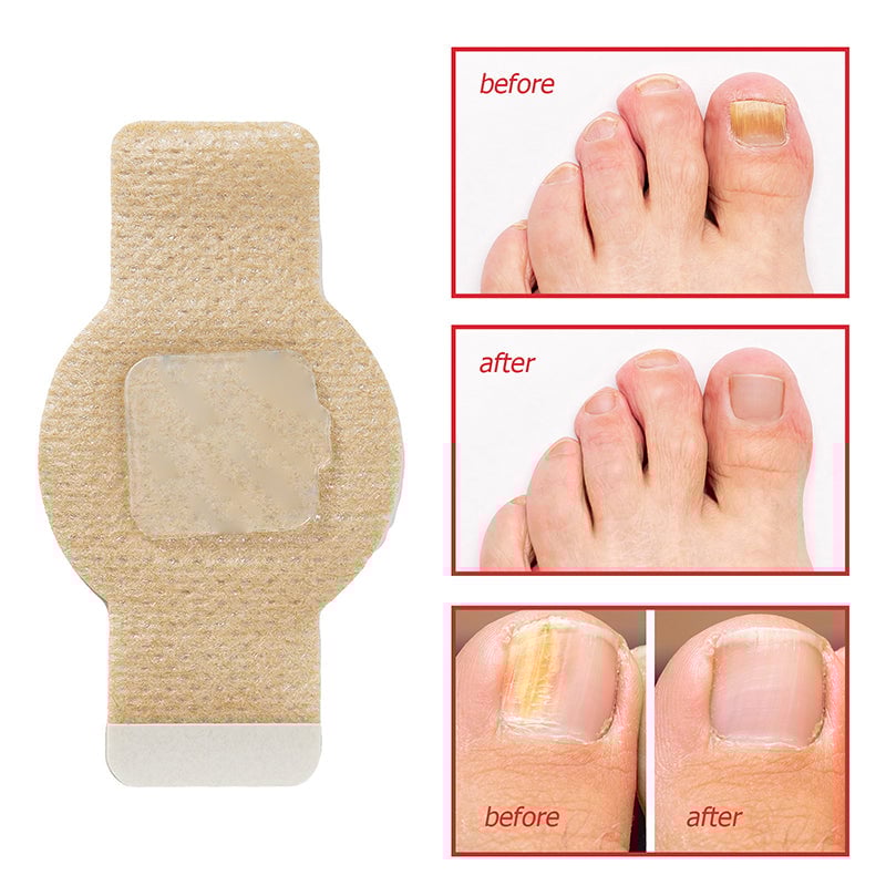 Fungal Nail Patches