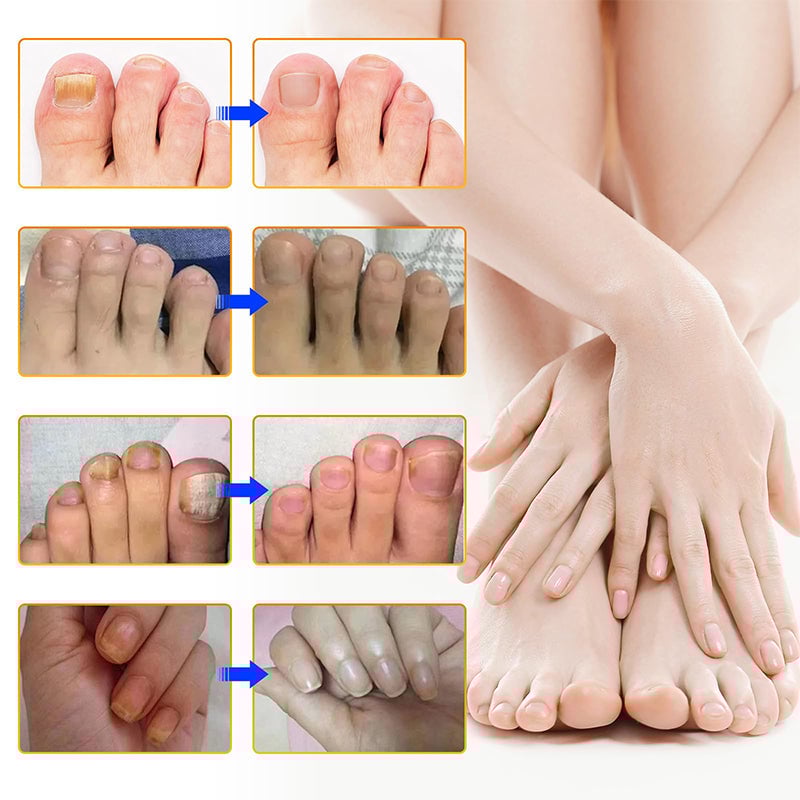 Fungal Nail Patches