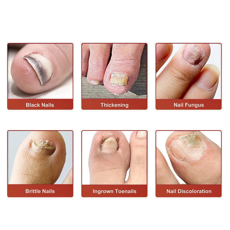 Fungal Nail Patches